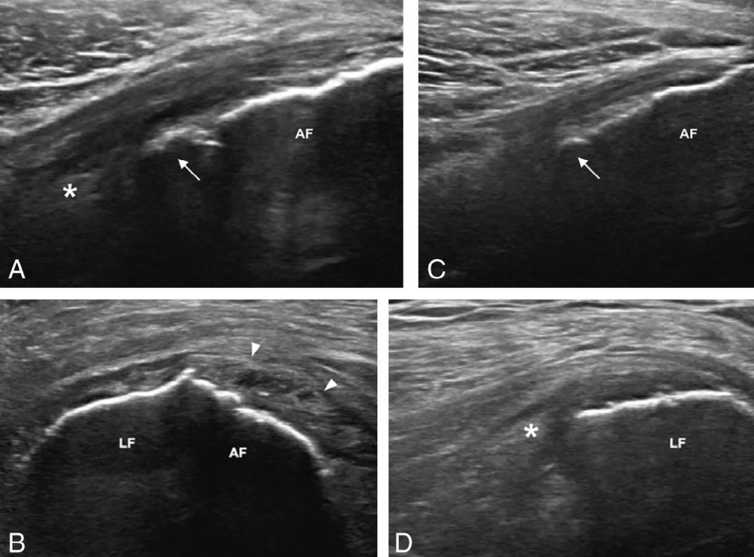 Gluteo menor 4 ecografia tempo formacion.jpg